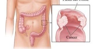 factores-involucrados-en-la-progresion-del-cancer-de-colon-universia-espana