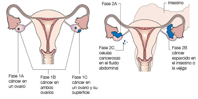 estadios del cancer de ovario